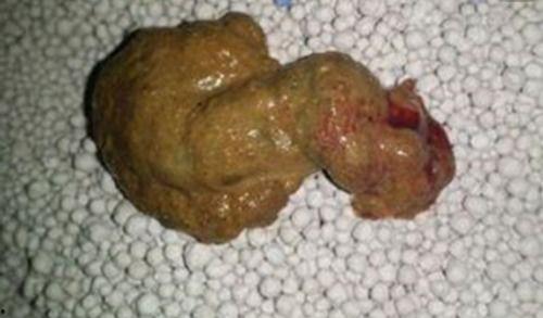 吃二甲双瓜拉黑屎正常吗,正常现象还是健康警示？